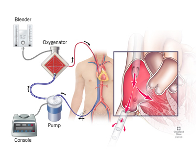 Extracorporeal Membrane Oxygenator